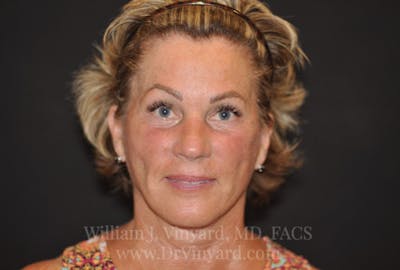 Facelift (Cheek and Neck Lift) Before & After Gallery - Patient 169743456 - Image 2