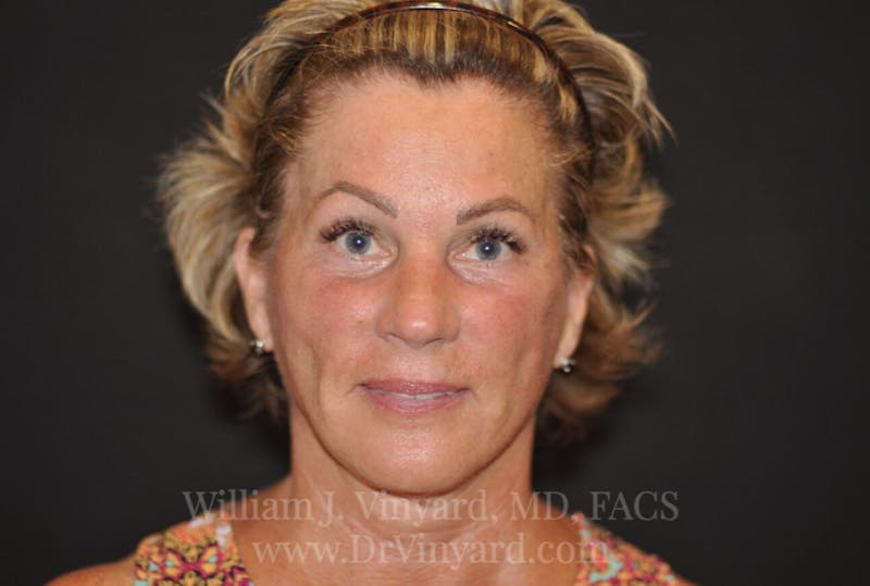 Facelift Before & After Gallery - Patient 169743456 - Image 2