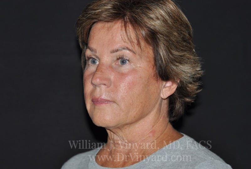 Facelift Before & After Gallery - Patient 169743456 - Image 3
