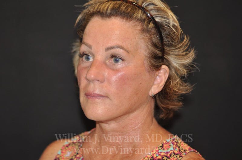 Facelift Before & After Gallery - Patient 169743456 - Image 4