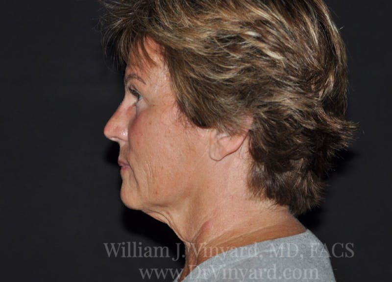 Facelift Before & After Gallery - Patient 169743456 - Image 5
