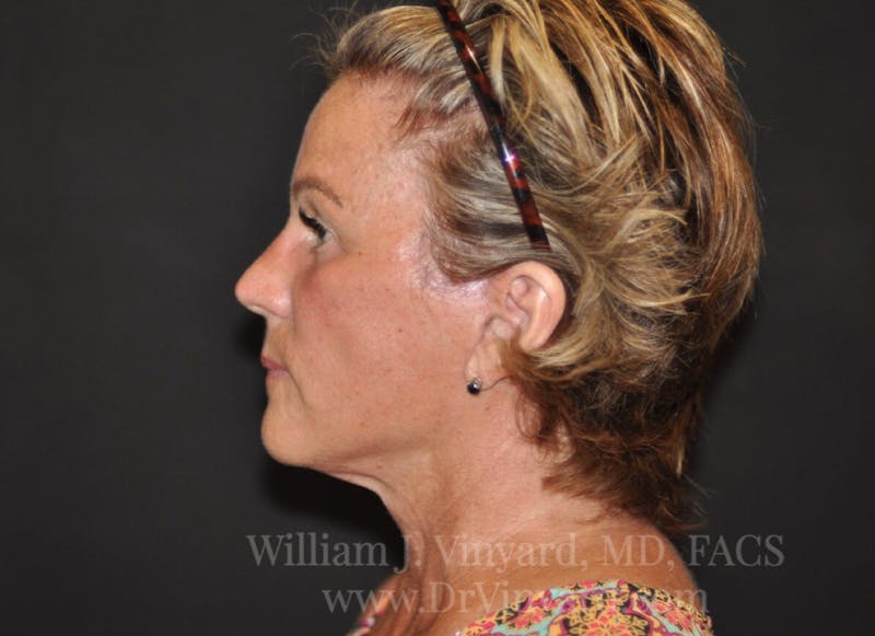 Facelift Before & After Gallery - Patient 169743456 - Image 6