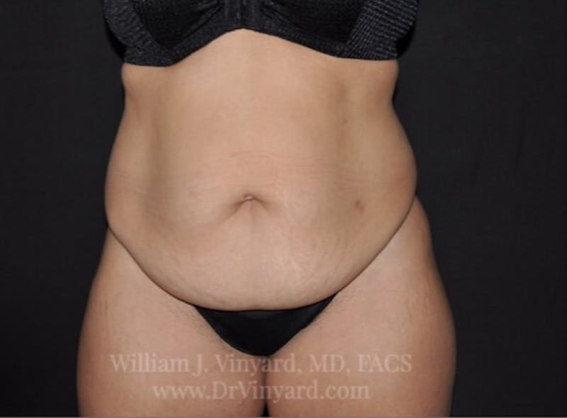 Tummy Tuck Before & After Gallery - Patient 171441505 - Image 1