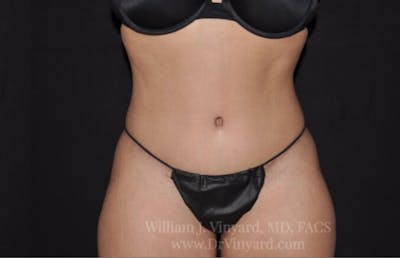 Tummy Tuck Before & After Gallery - Patient 171441505 - Image 2