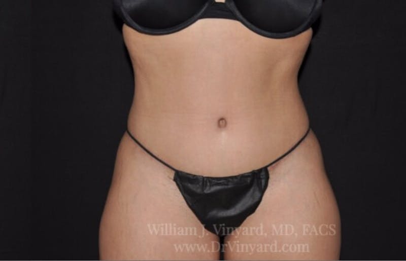 Tummy Tuck Before & After Gallery - Patient 171441505 - Image 2