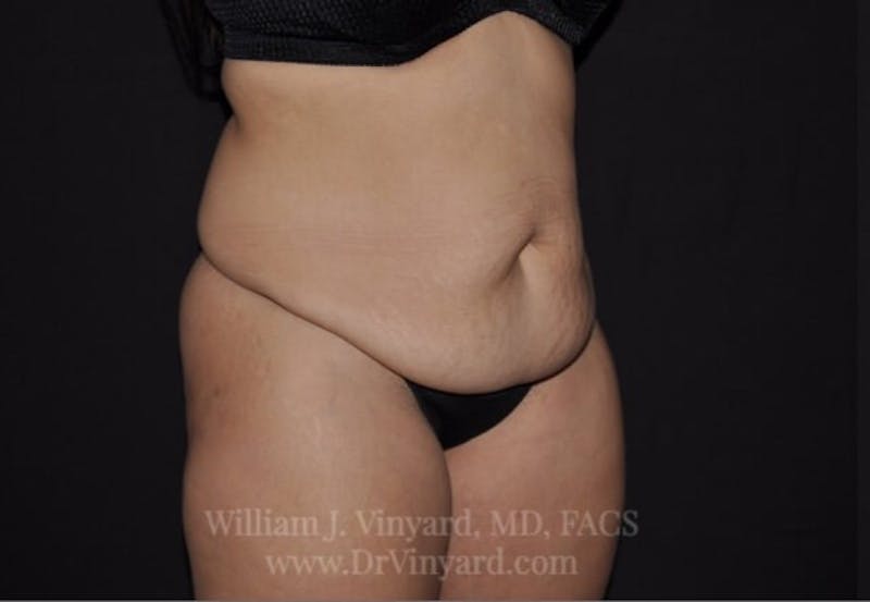 Tummy Tuck Before & After Gallery - Patient 171441505 - Image 3