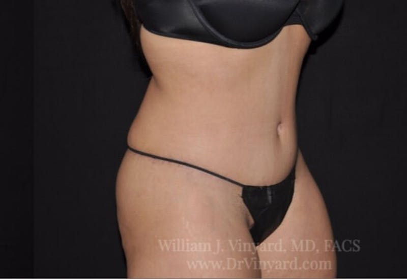 Tummy Tuck Before & After Gallery - Patient 171441505 - Image 4