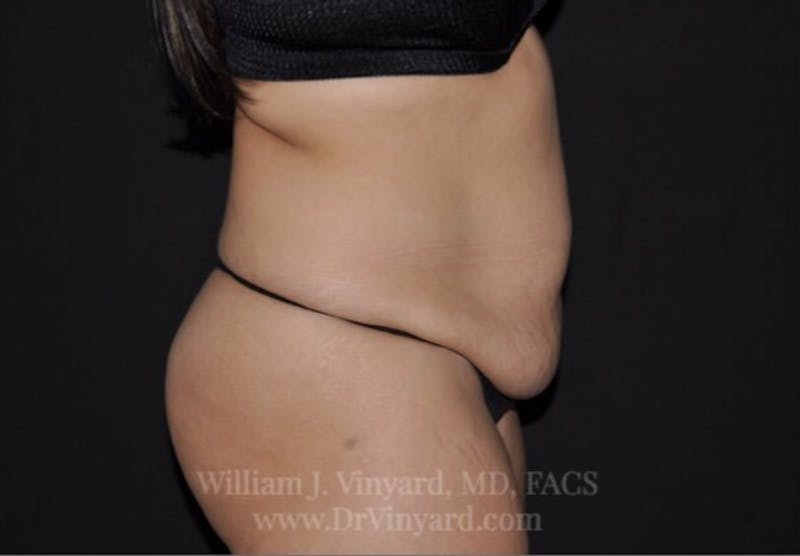 Tummy Tuck Before & After Gallery - Patient 171441505 - Image 5