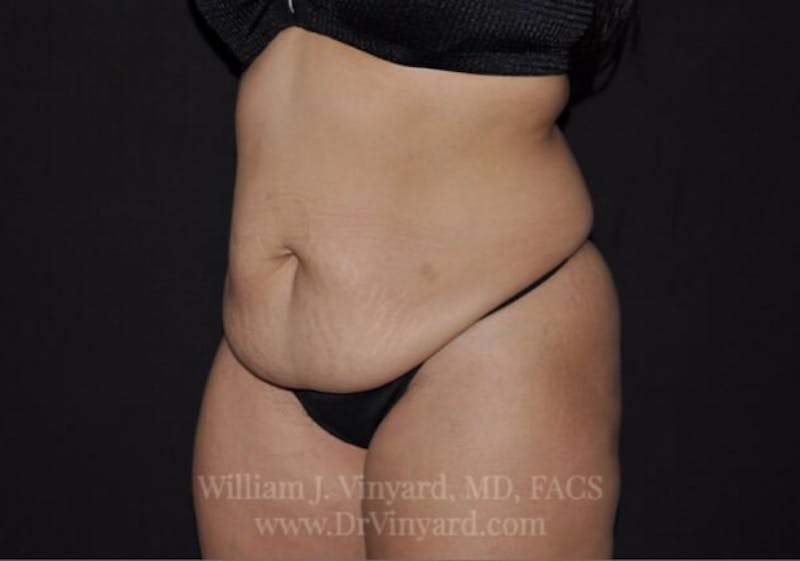 Tummy Tuck Before & After Gallery - Patient 171441505 - Image 7