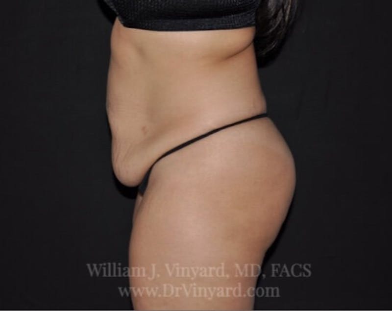 Tummy Tuck Before & After Gallery - Patient 171441505 - Image 9