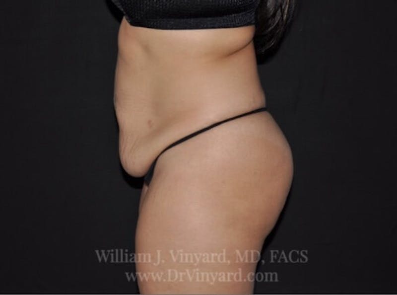 Tummy Tuck Before & After Gallery - Patient 171441505 - Image 10