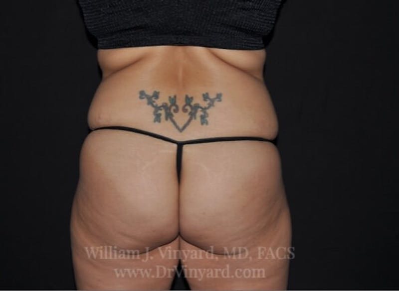 Tummy Tuck Before & After Gallery - Patient 171441505 - Image 11