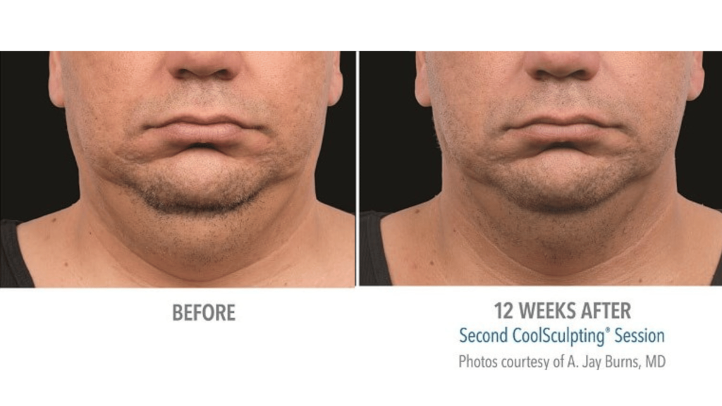 chin coolsculpting (1)