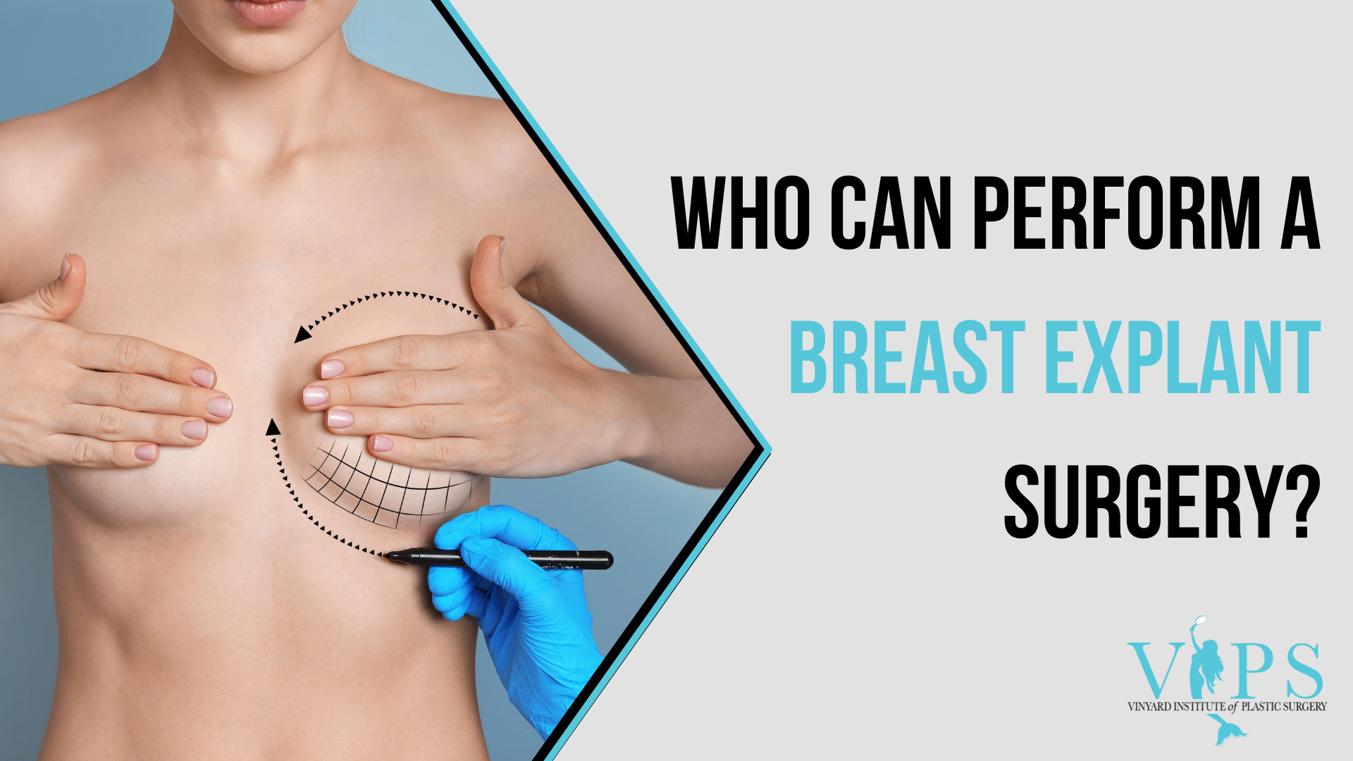 Who Can Perform a Breast Explant Surgery?