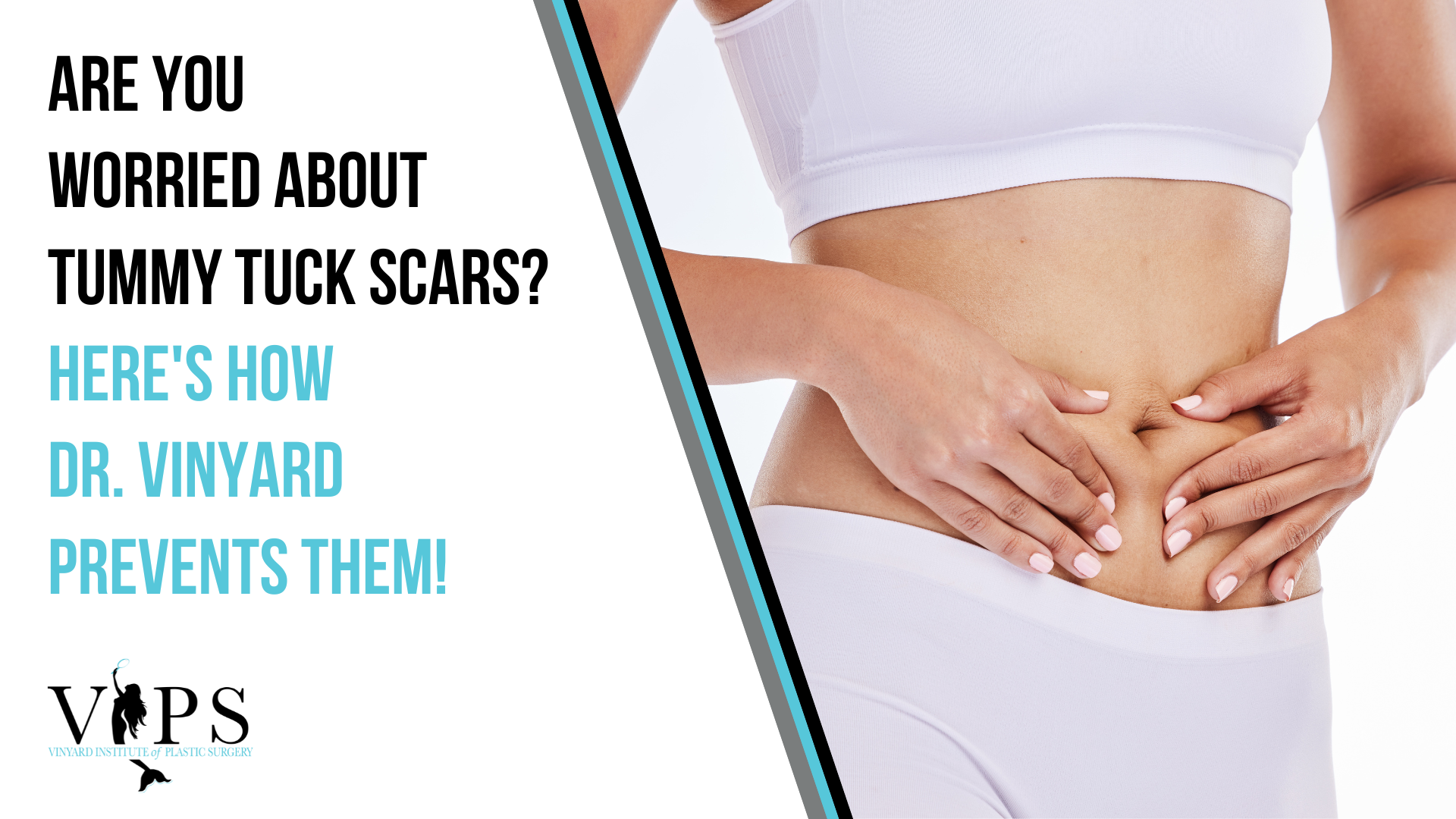 Are You Worried About Tummy Tuck Scars? Here's How Dr. Vinyard