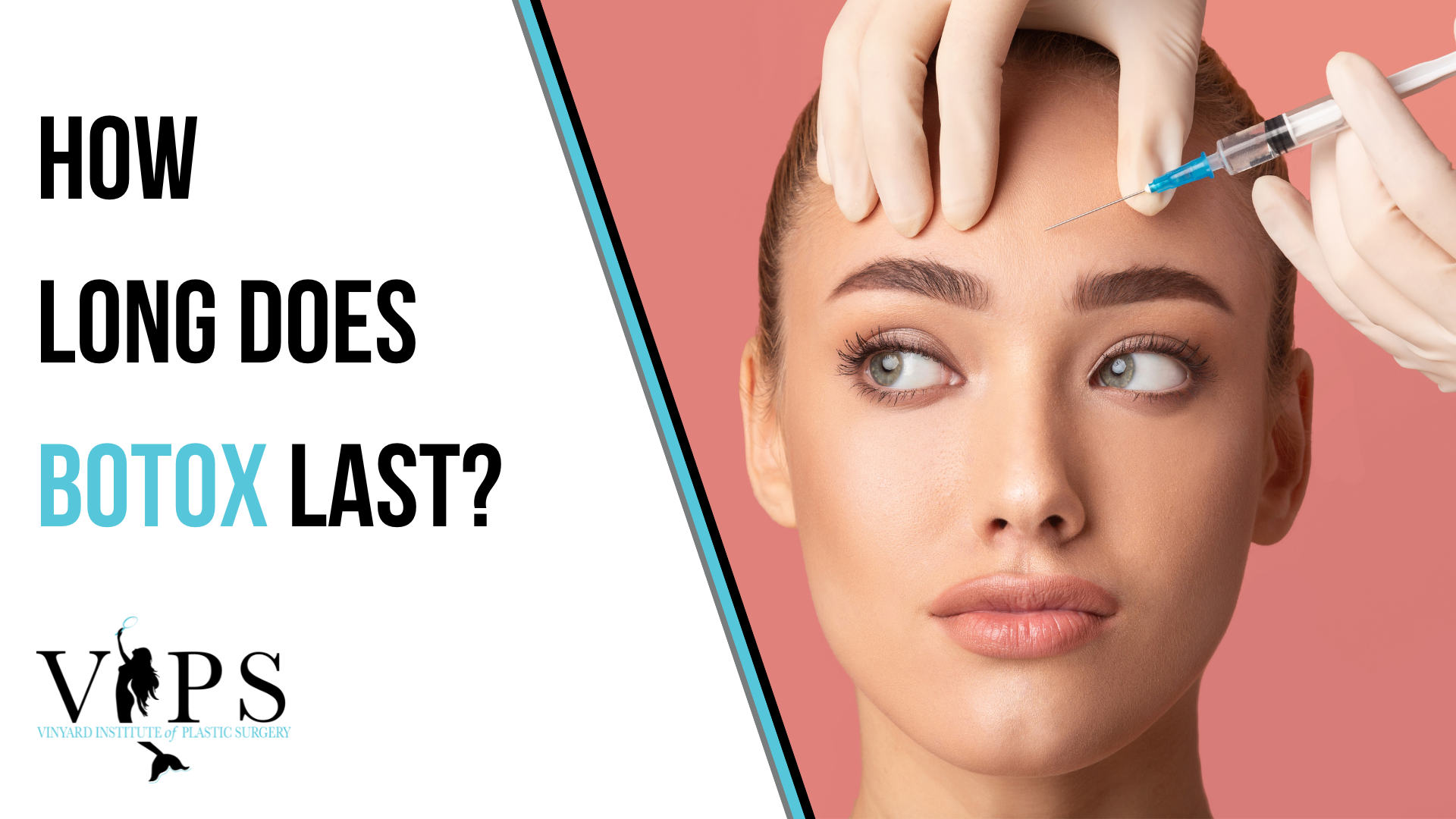 tirzepatide and botox How Long Does BOTOX Last?