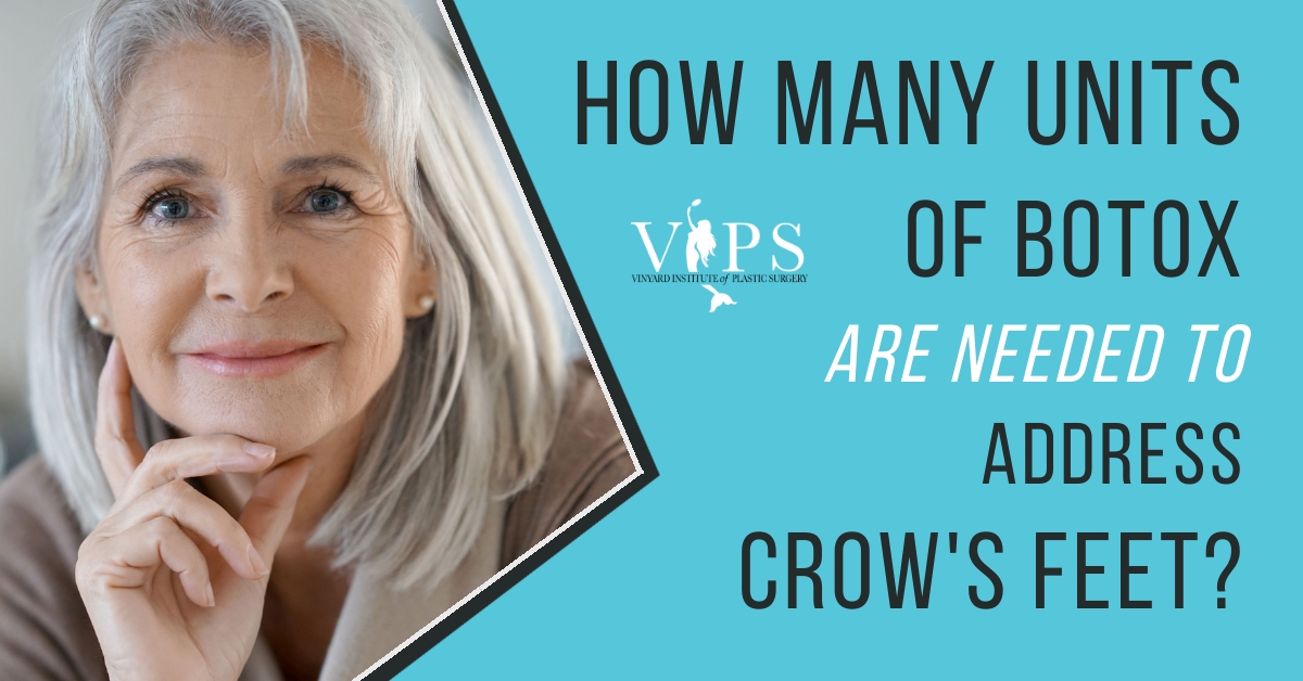 How many units of Botox are needed to address Crow's feet? Vinyard