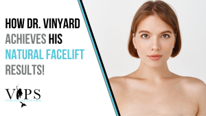 march blog#5 how dr. vinyard achieves his natural facelift results!