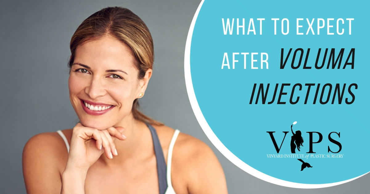 What To Expect After Voluma Injections