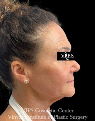 ELLUMINATE WITH IPL Before & After Gallery - Patient 189403 - Image 4