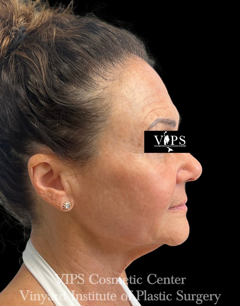 ELLUMINATE WITH IPL Before & After Gallery - Patient 189403 - Image 4