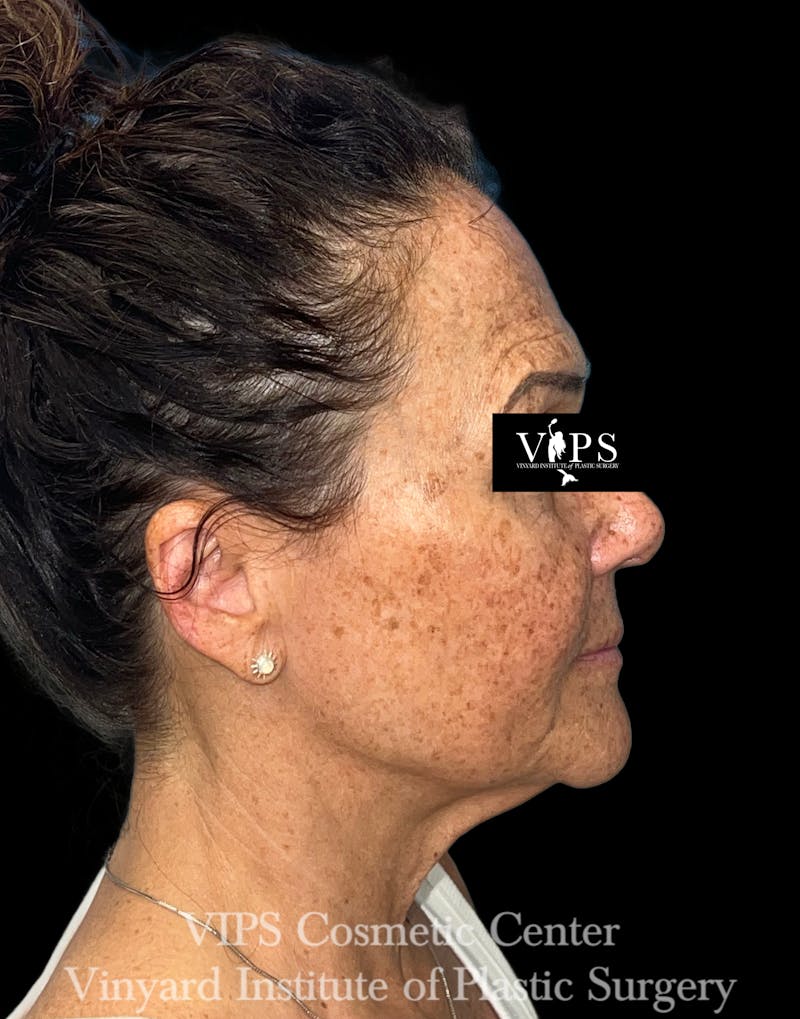 ELLUMINATE WITH IPL Before & After Gallery - Patient 189403 - Image 3