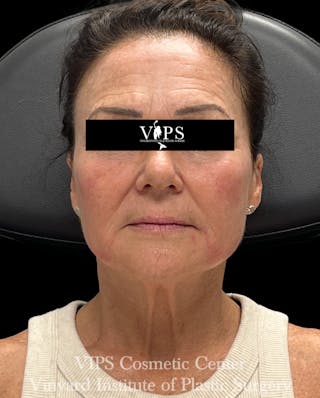 ELLUMINATE WITH IPL Before & After Gallery - Patient 189403 - Image 2