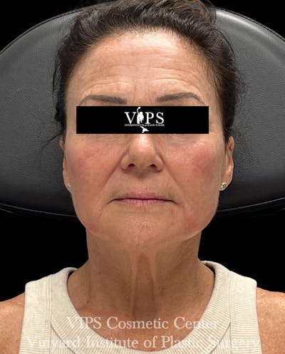 Elluminate Advanced Photofacial w/IPL Before & After Gallery - Patient 189403 - Image 2
