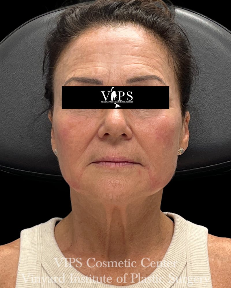 ELLUMINATE WITH IPL Before & After Gallery - Patient 189403 - Image 2