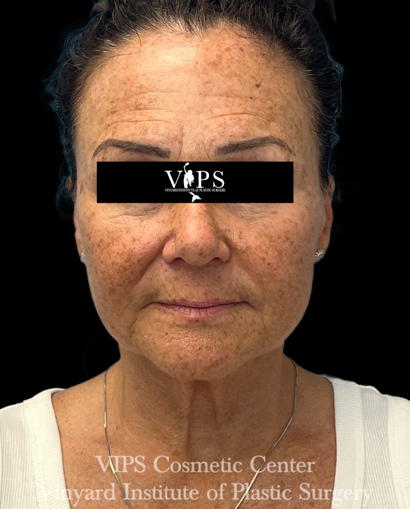 ELLUMINATE WITH IPL Before & After Gallery - Patient 189403 - Image 1