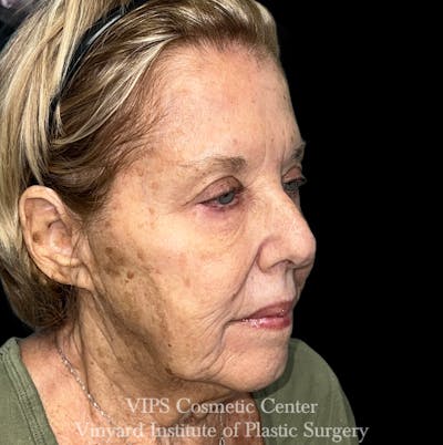 Elluminate Advanced Photofacial w/IPL Before & After Gallery - Patient 318871 - Image 1