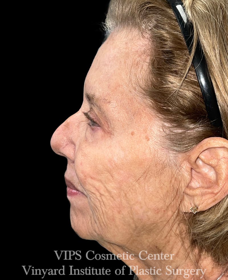 ELLUMINATE WITH IPL Before & After Gallery - Patient 391383 - Image 6