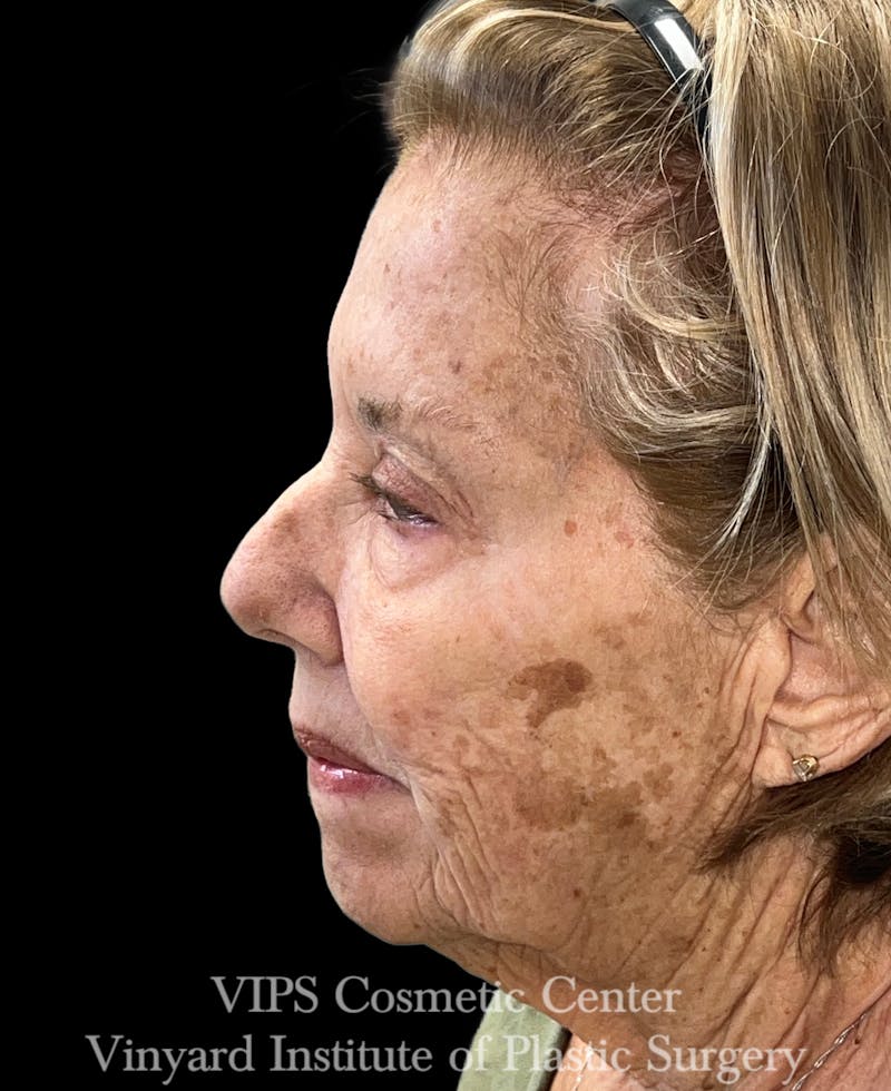 ELLUMINATE WITH IPL Before & After Gallery - Patient 391383 - Image 5