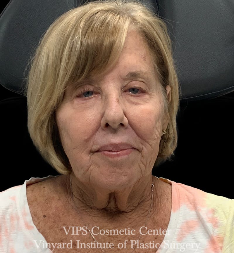ELLUMINATE WITH IPL Before & After Gallery - Patient 391383 - Image 2
