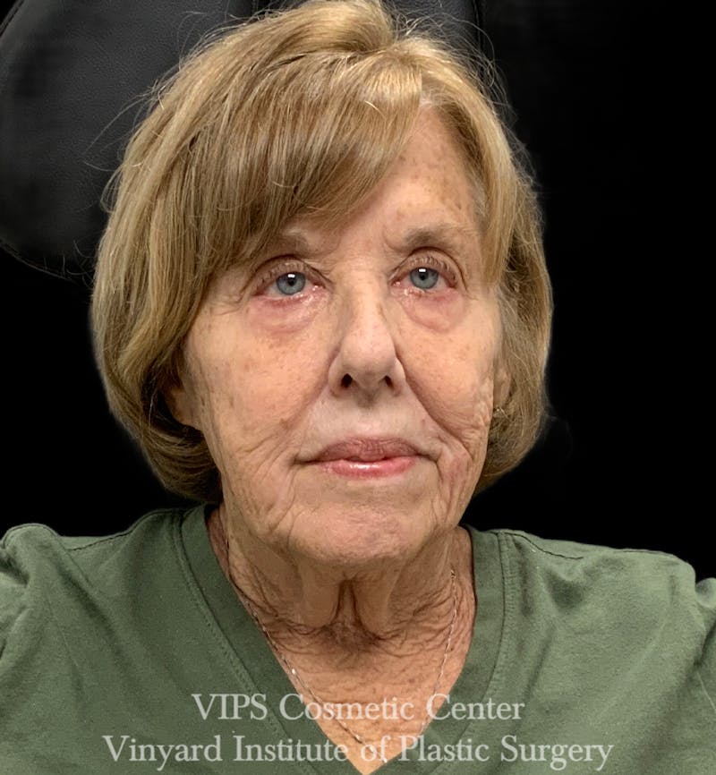 ELLUMINATE WITH IPL Before & After Gallery - Patient 391383 - Image 1