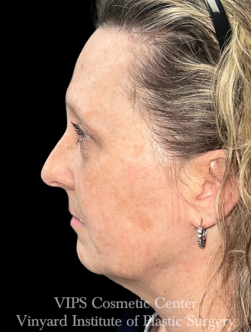 ELLUMINATE WITH IPL Before & After Gallery - Patient 293472 - Image 6