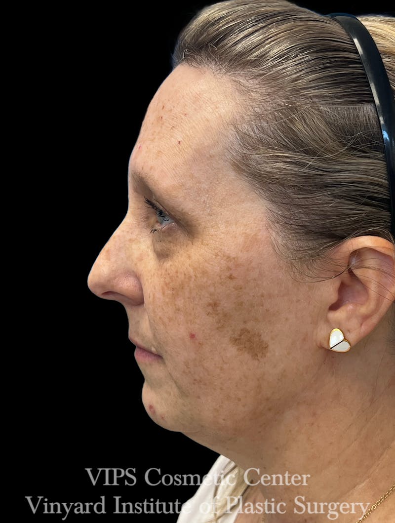 ELLUMINATE WITH IPL Before & After Gallery - Patient 293472 - Image 5