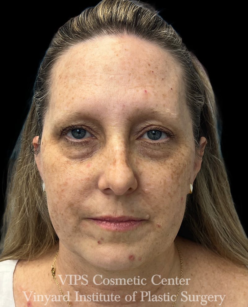 ELLUMINATE WITH IPL Before & After Gallery - Patient 293472 - Image 1