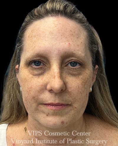 ELLUMINATE WITH IPL Before & After Gallery - Patient 293472 - Image 1