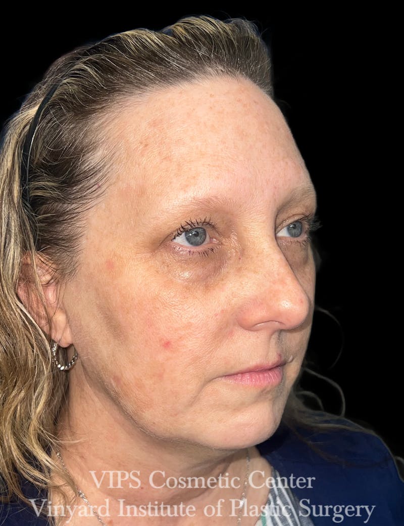 ELLUMINATE WITH IPL Before & After Gallery - Patient 293472 - Image 4