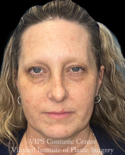 Elluminate Advanced Photofacial w/IPL Before & After Gallery - Patient 293472 - Image 2