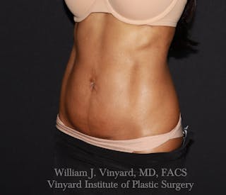 BodyTite Before & After Gallery - Patient 363008 - Image 2