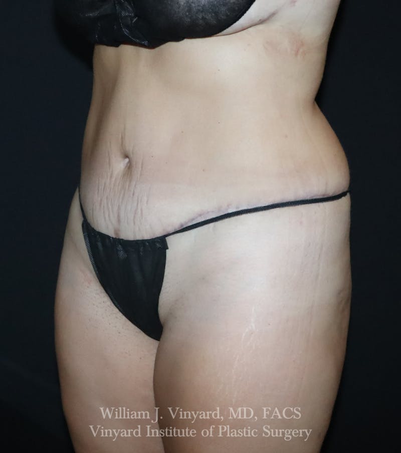 Tummy Tuck Before & After Gallery - Patient 391502 - Image 8
