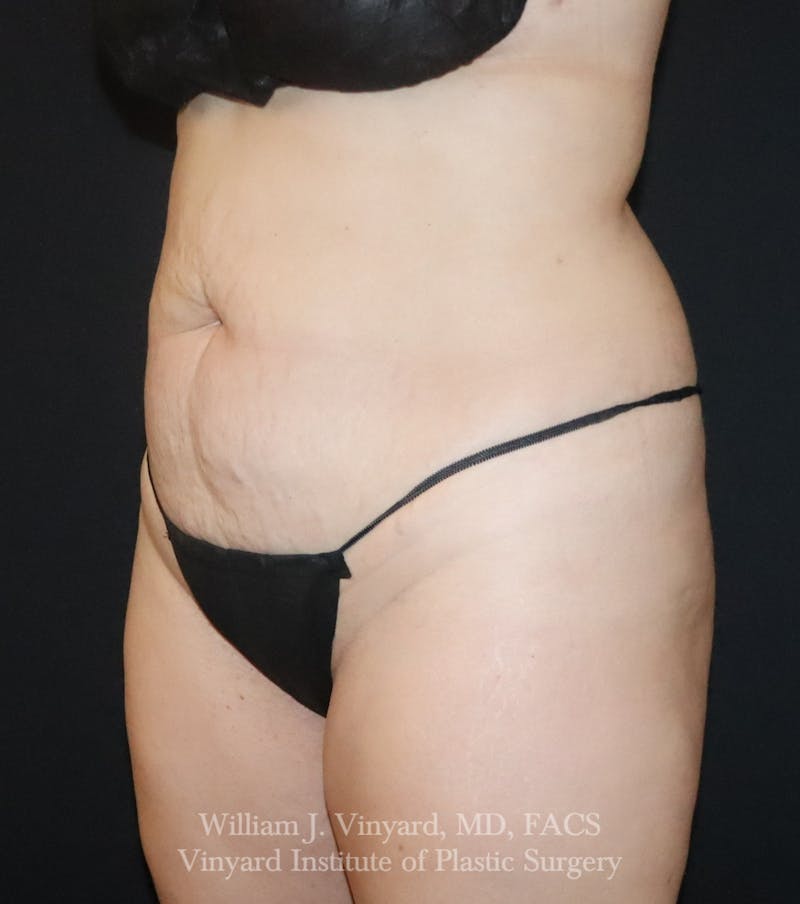 Tummy Tuck Before & After Gallery - Patient 300749 - Image 3