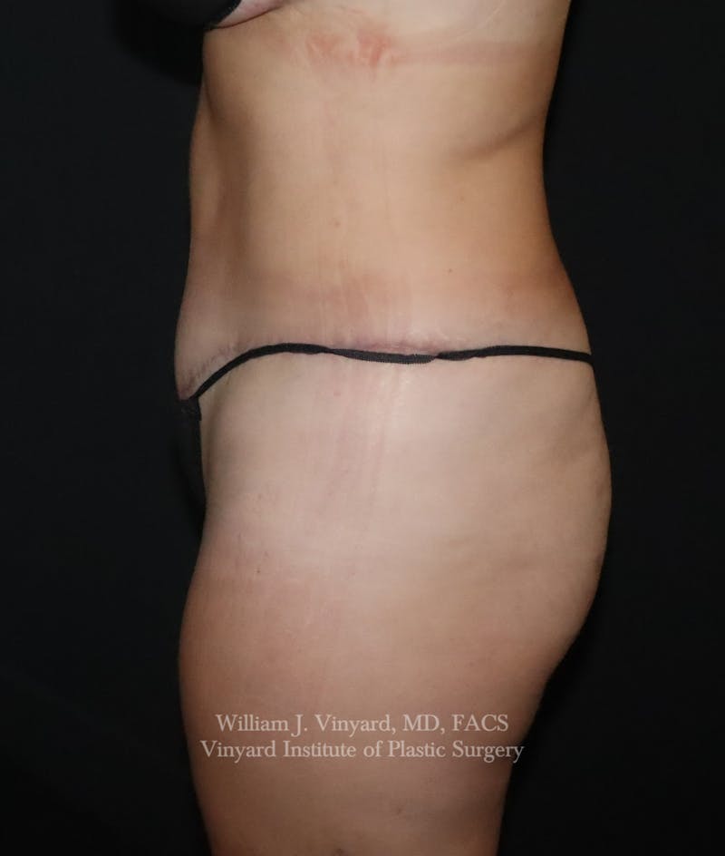Tummy Tuck Before & After Gallery - Patient 391502 - Image 10
