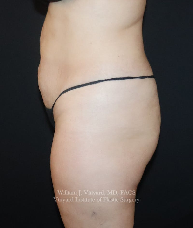 Tummy Tuck Before & After Gallery - Patient 391502 - Image 9