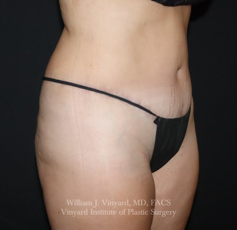 Tummy Tuck Before & After Gallery - Patient 391502 - Image 4