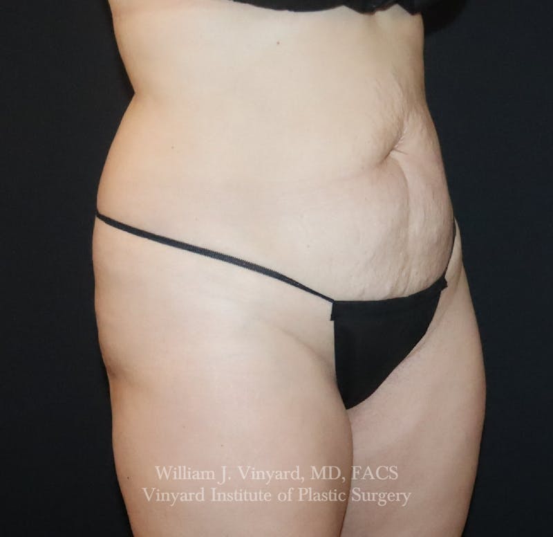 Tummy Tuck Before & After Gallery - Patient 391502 - Image 3