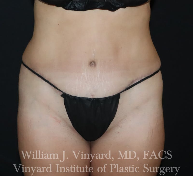 Tummy Tuck Before & After Gallery - Patient 300749 - Image 2