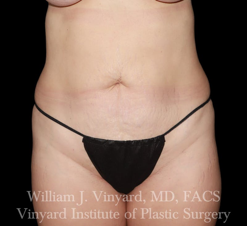 Tummy Tuck Before & After Gallery - Patient 300749 - Image 1